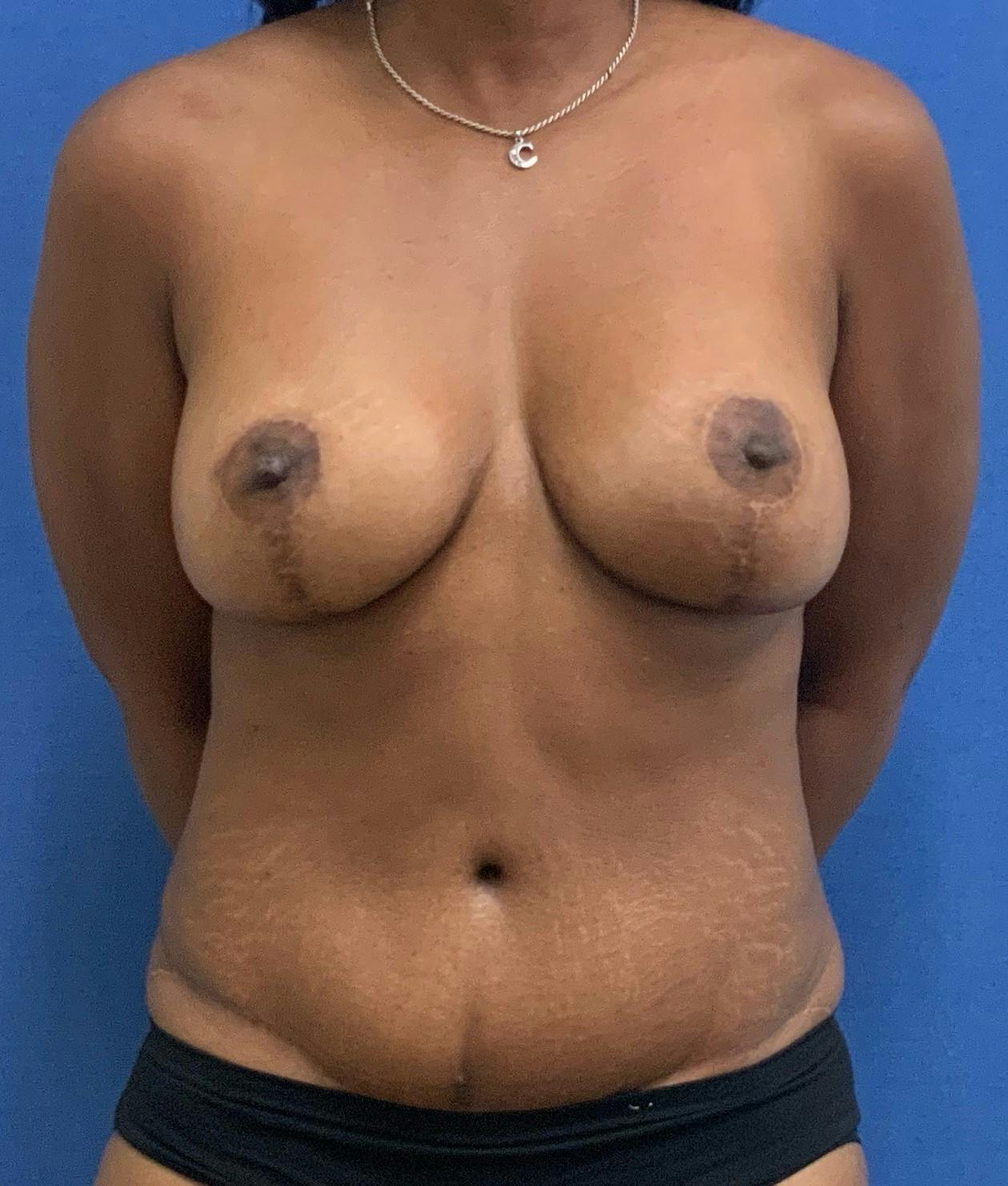 Dr. Hollie Hickman Before & After Gallery - Patient 369784 - Image 2