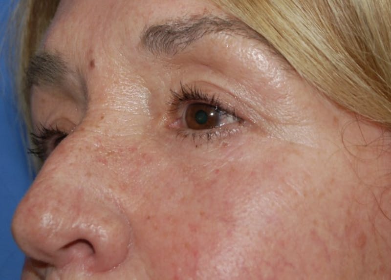 Dr. Robert Burk Before & After Gallery - Patient 306135 - Image 6