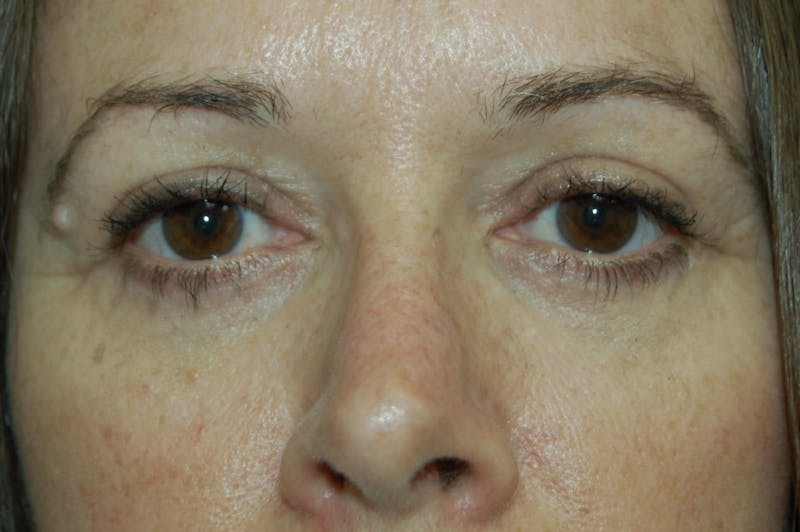 Dr. Robert Burk Before & After Gallery - Patient 279620 - Image 2