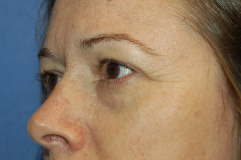 Dr. Robert Burk Before & After Gallery - Patient 279620 - Image 5