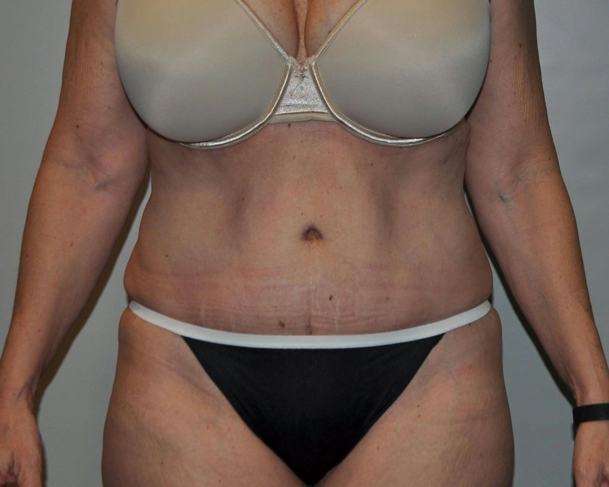 Dr. Hollie Hickman Before & After Gallery - Patient 246168 - Image 2