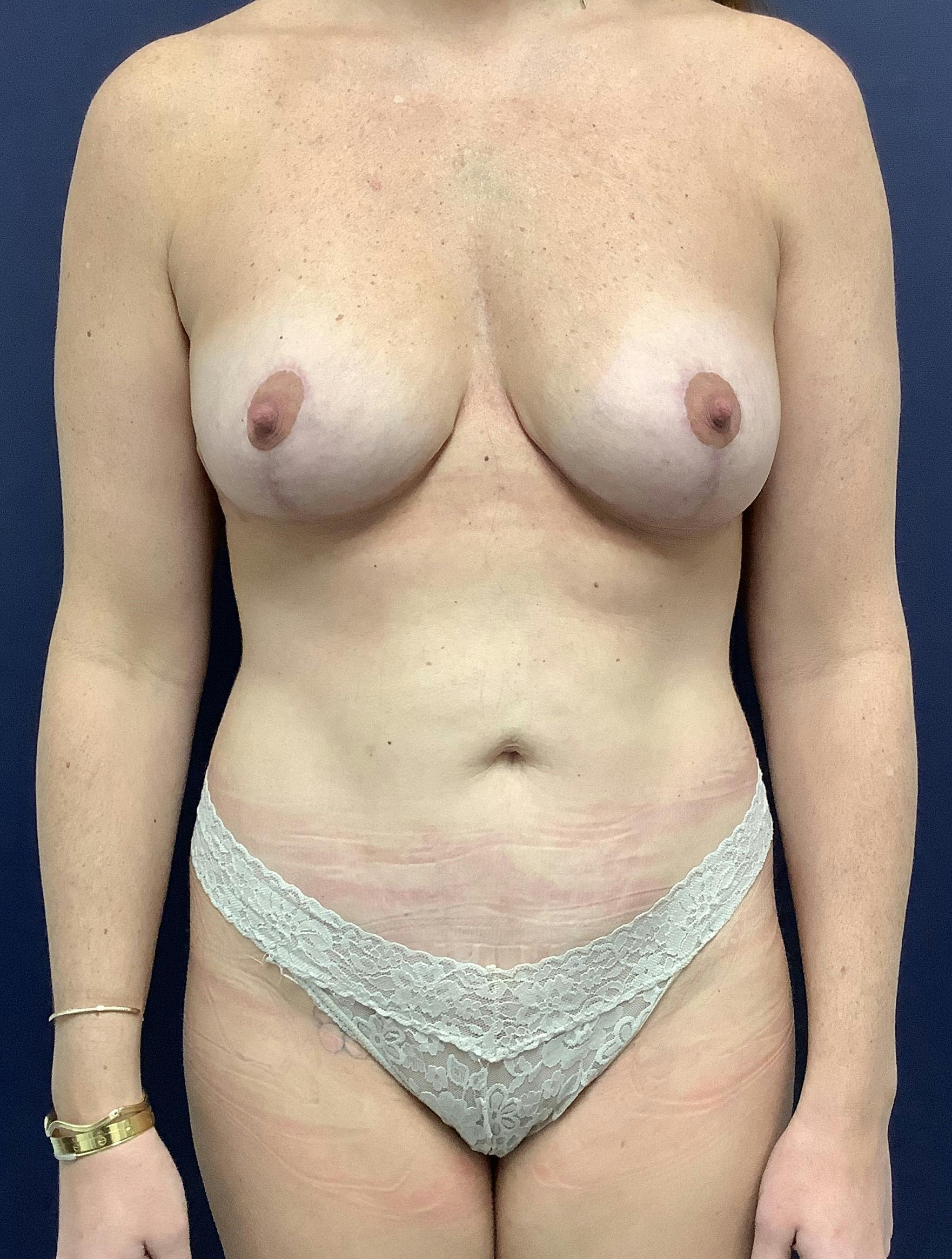 Dr. Chris Bates Before & After Gallery - Patient 403288 - Image 2