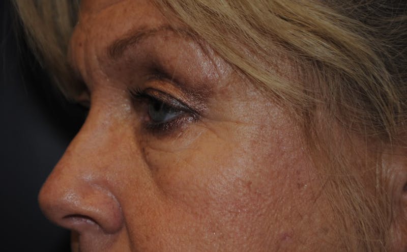 Dr. Robert Burk Before & After Gallery - Patient 122934 - Image 5