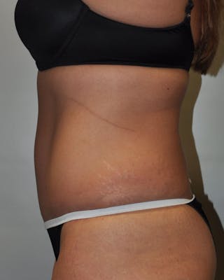 Dr. Hollie Hickman Before & After Gallery - Patient 195775 - Image 6