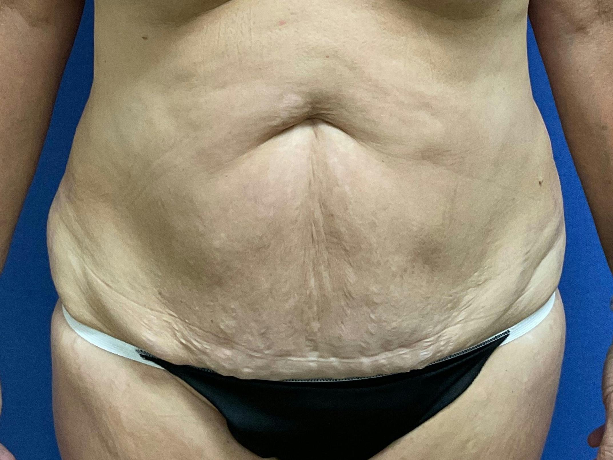 Dr. Chris Bates Before & After Gallery - Patient 272147 - Image 1