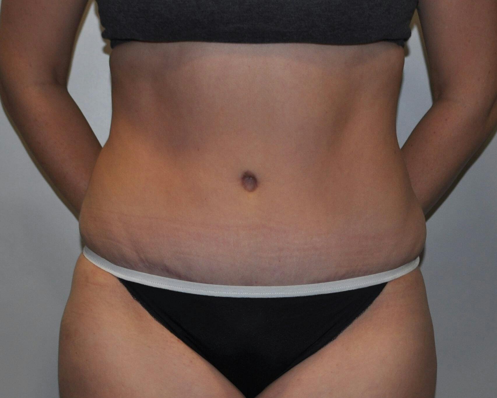 Dr. Hollie Hickman Before & After Gallery - Patient 245715 - Image 2