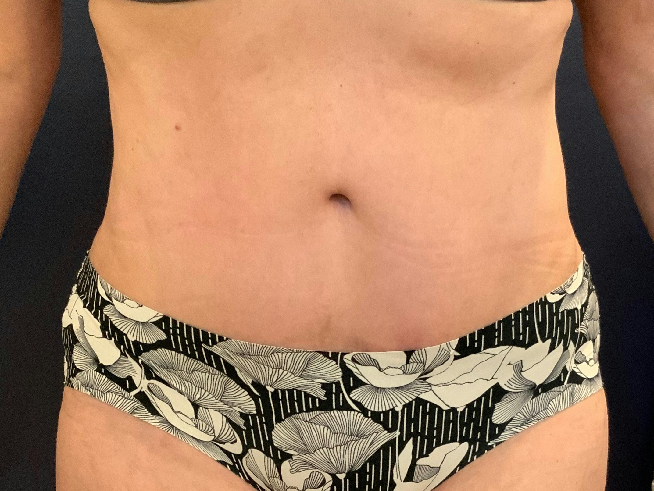 Dr. Chris Bates Before & After Gallery - Patient 272147 - Image 2