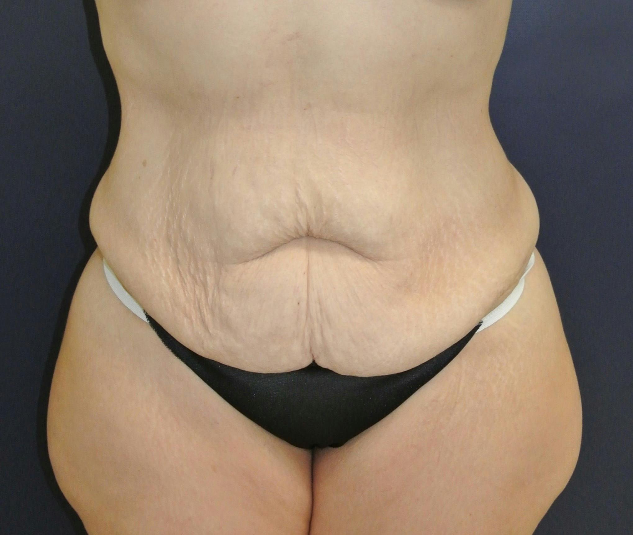 Dr. Chris Bates Before & After Gallery - Patient 404939 - Image 1