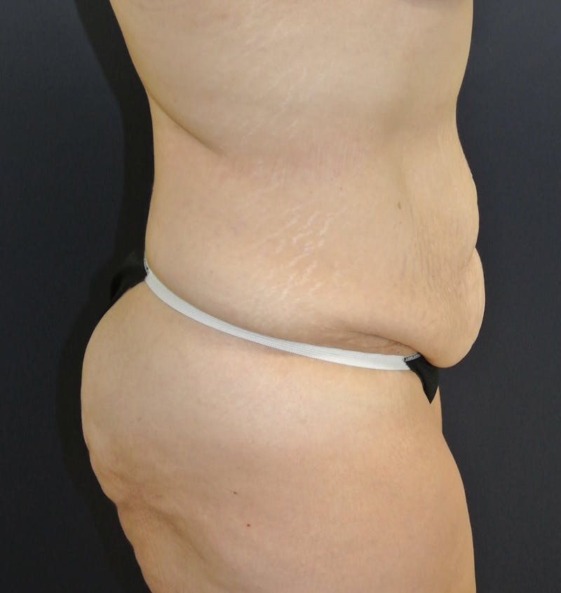 Dr. Chris Bates Before & After Gallery - Patient 404939 - Image 3
