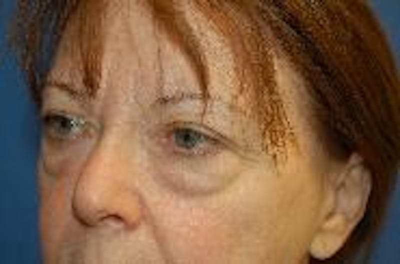 Dr. Robert Burk Before & After Gallery - Patient 216779 - Image 3