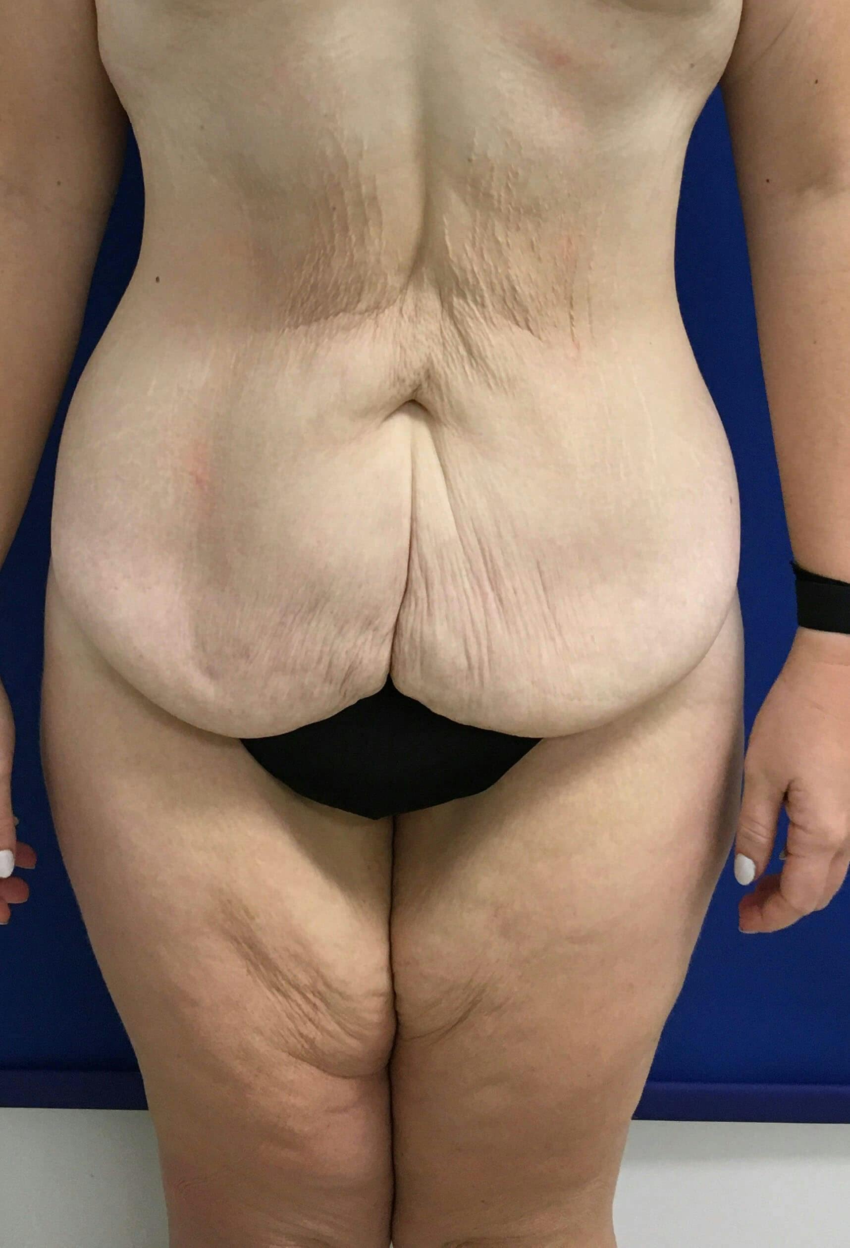 Dr. Chris Bates Before & After Gallery - Patient 151554 - Image 1