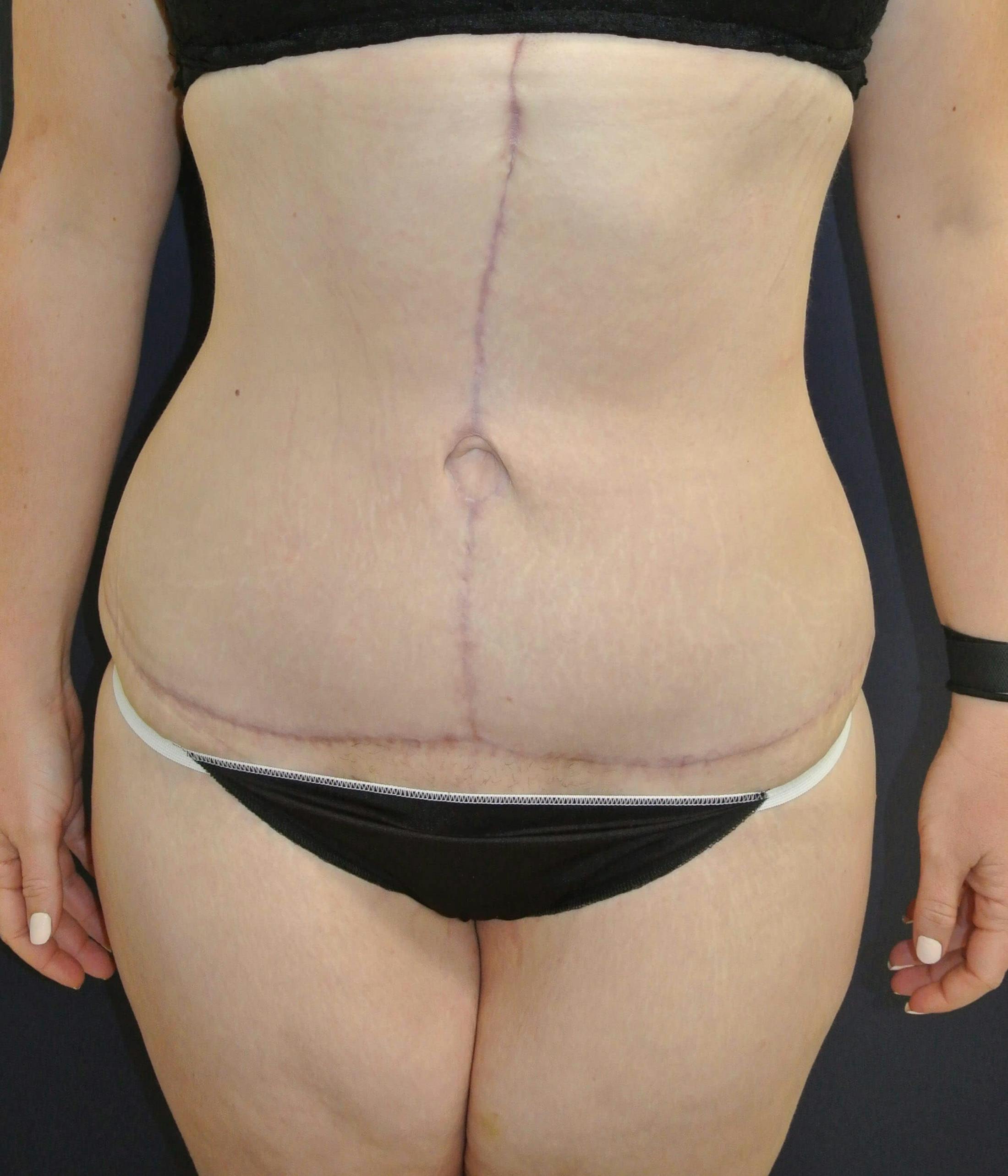 Dr. Chris Bates Before & After Gallery - Patient 151554 - Image 2