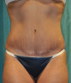Dr. Hollie Hickman Before & After Gallery - Patient 122077 - Image 2