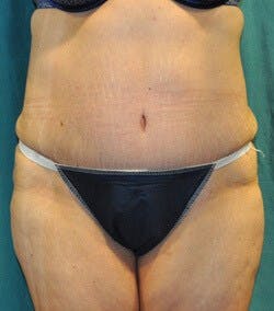 Dr. Hollie Hickman Before & After Gallery - Patient 853096 - Image 2