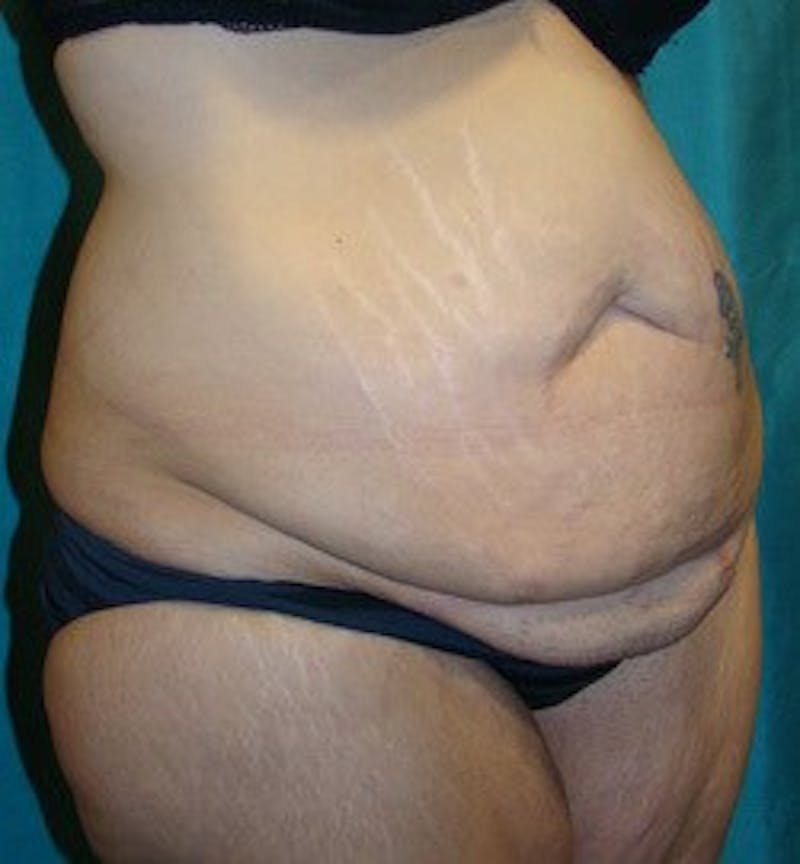 Dr. Hollie Hickman Before & After Gallery - Patient 287830 - Image 3
