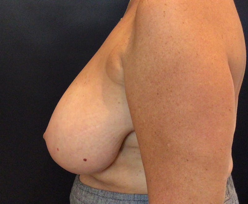 Dr. Ellen Hancock Before & After Gallery - Patient 708049 - Image 5