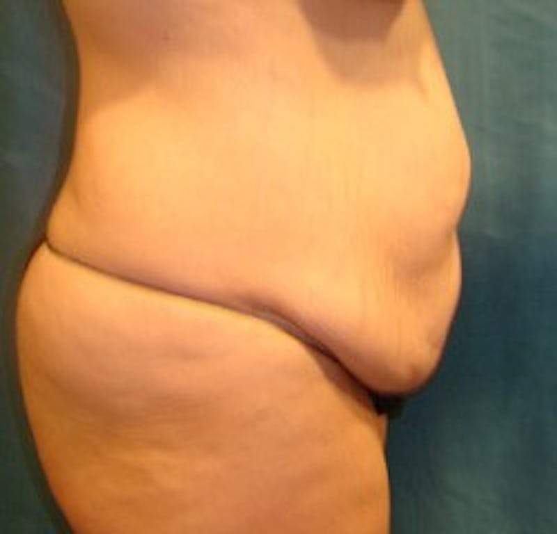 Dr. Hollie Hickman Before & After Gallery - Patient 350385 - Image 3