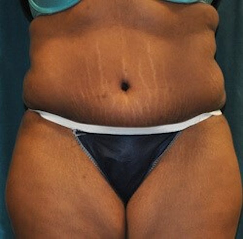 Dr. Hollie Hickman Before & After Gallery - Patient 339804 - Image 2