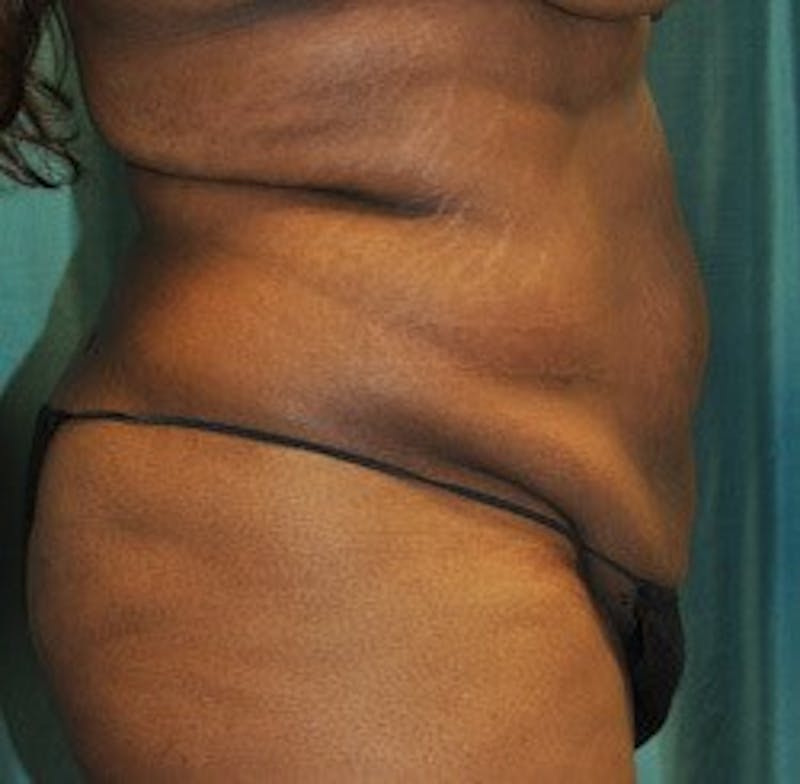 Dr. Hollie Hickman Before & After Gallery - Patient 339804 - Image 3
