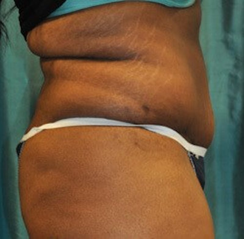 Dr. Hollie Hickman Before & After Gallery - Patient 339804 - Image 4