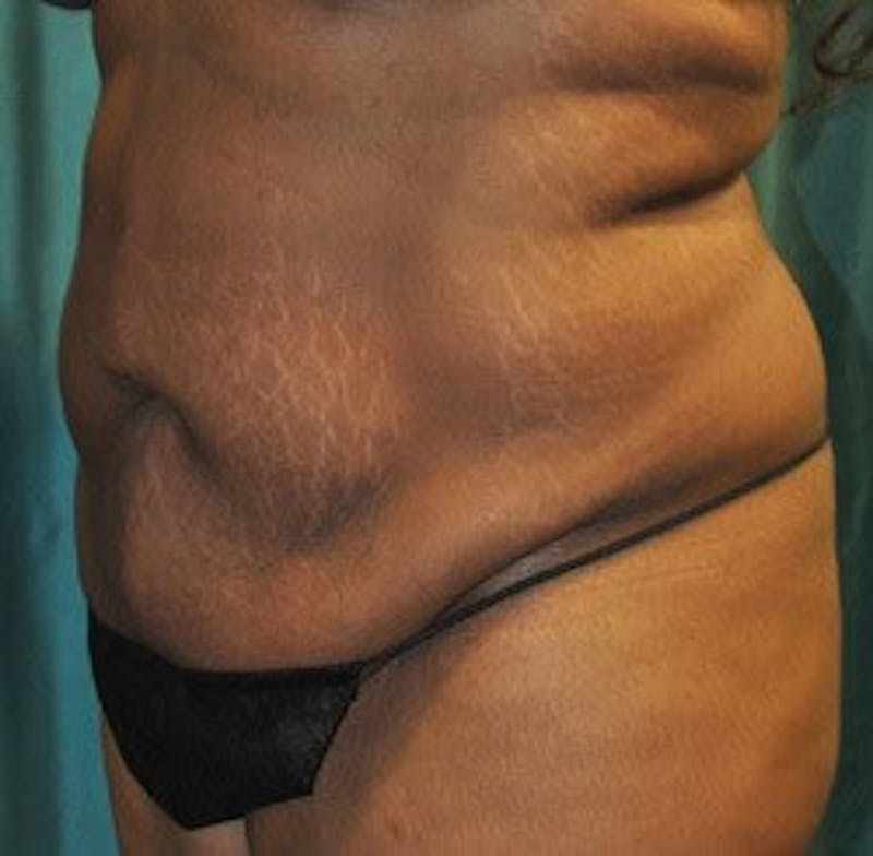 Dr. Hollie Hickman Before & After Gallery - Patient 339804 - Image 5