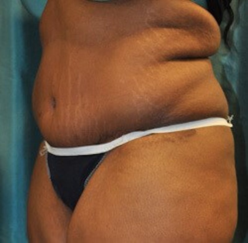 Dr. Hollie Hickman Before & After Gallery - Patient 339804 - Image 6