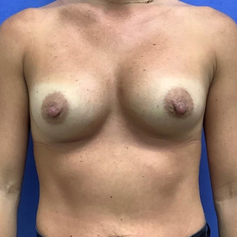 Dr. Ellen Hancock Before & After Gallery - Patient 258555 - Image 1