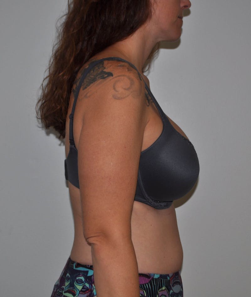 Dr. Hollie Hickman Before & After Gallery - Patient 374849 - Image 5