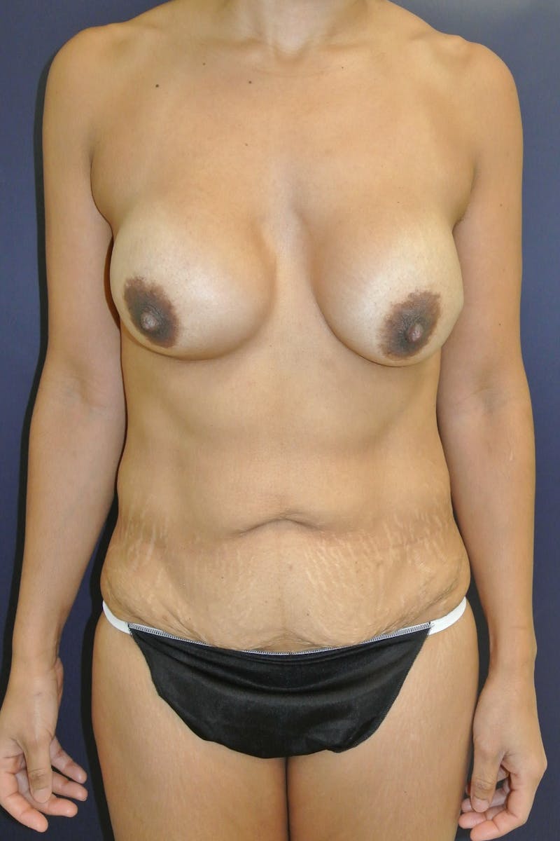 Dr. Chris Bates Before & After Gallery - Patient 217983 - Image 1
