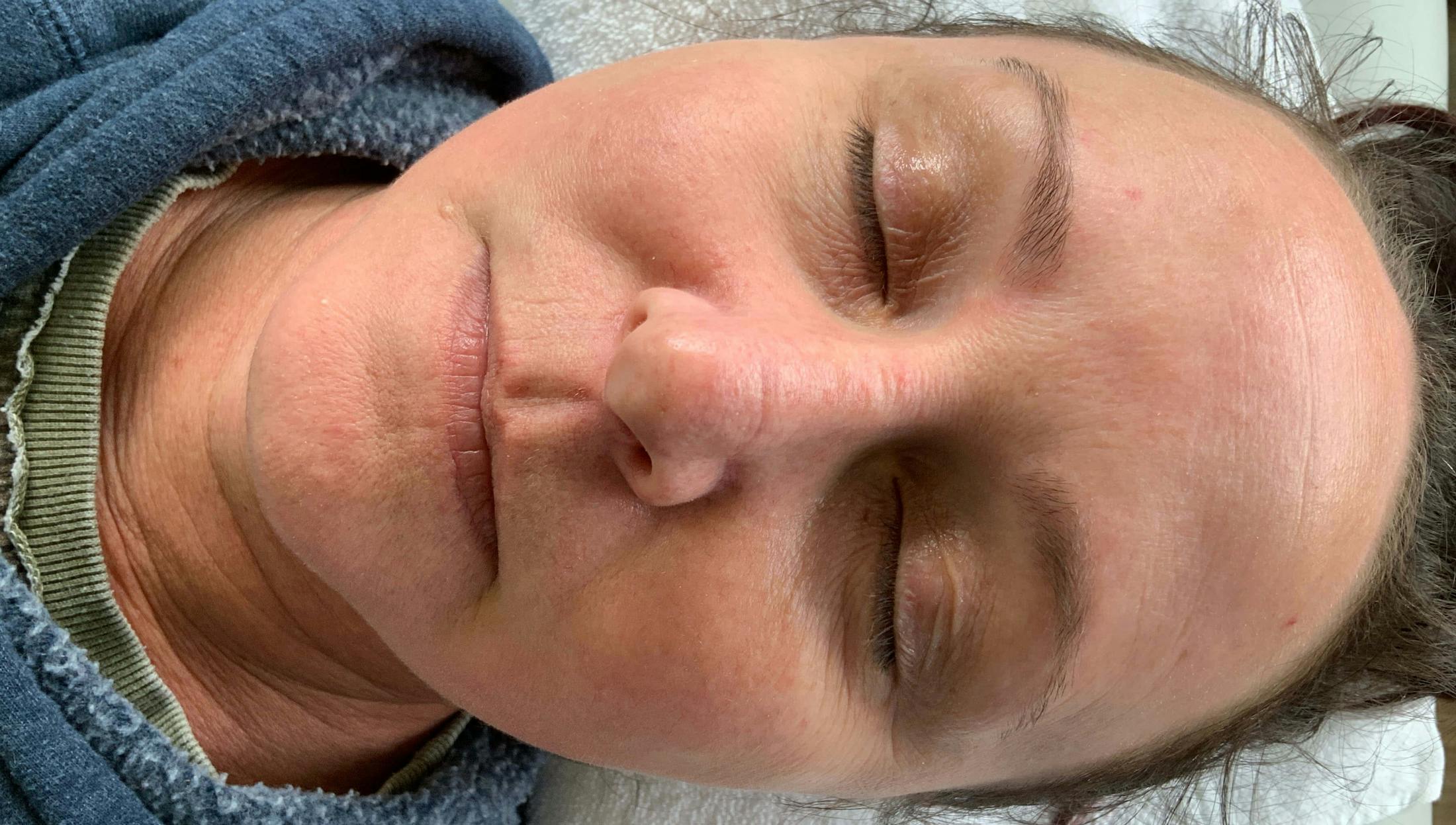 Kimberly Saffman, APRN Before & After Gallery - Patient 203476 - Image 2