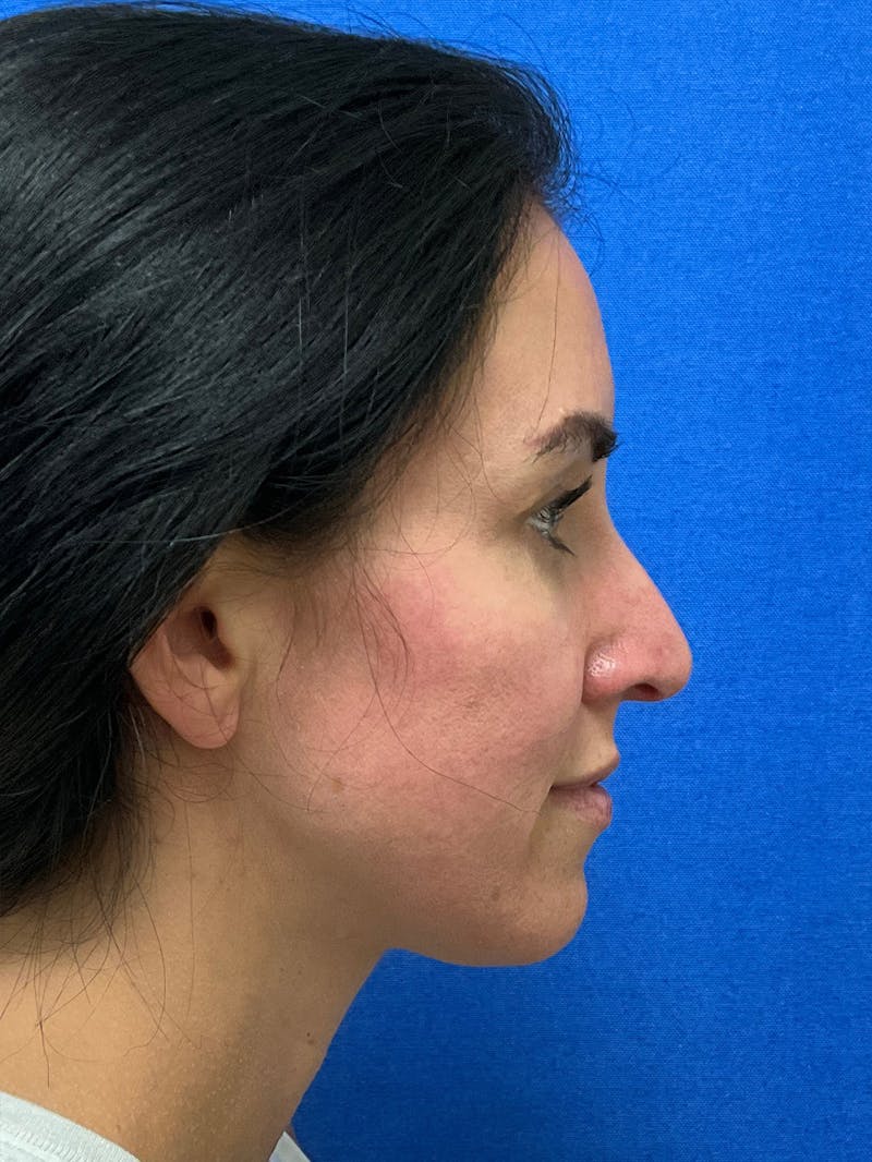 Dr. Ellen Hancock Before & After Gallery - Patient 158826 - Image 1