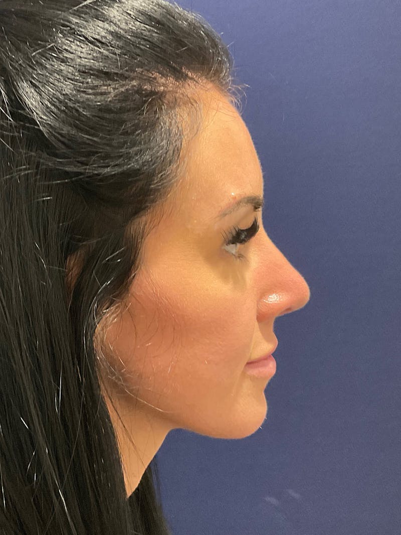 Dr. Ellen Hancock Before & After Gallery - Patient 158826 - Image 2