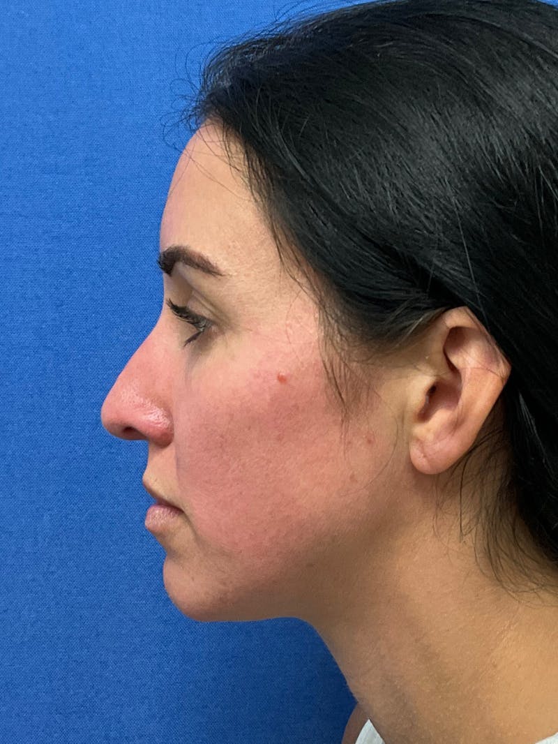 Dr. Ellen Hancock Before & After Gallery - Patient 158826 - Image 3