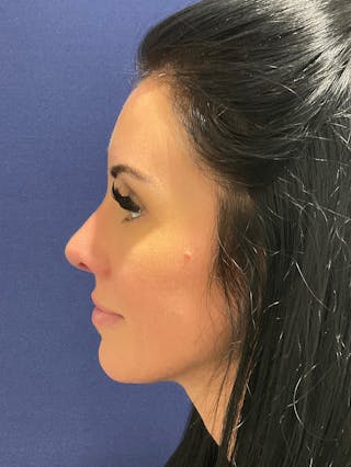 Dr. Ellen Hancock Before & After Gallery - Patient 158826 - Image 4