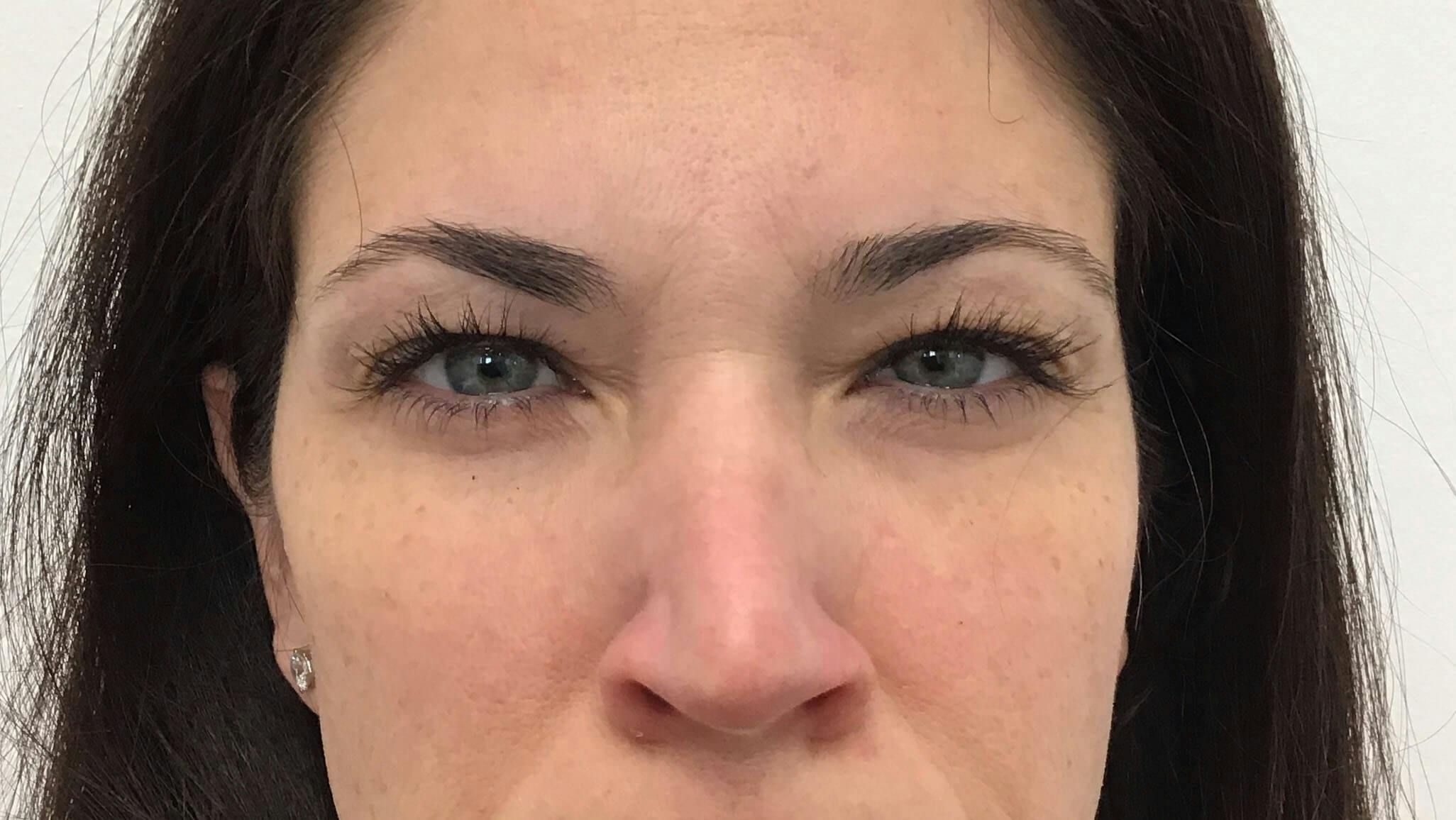 Amy Kadlubowski, APRN Before & After Gallery - Patient 413369 - Image 2