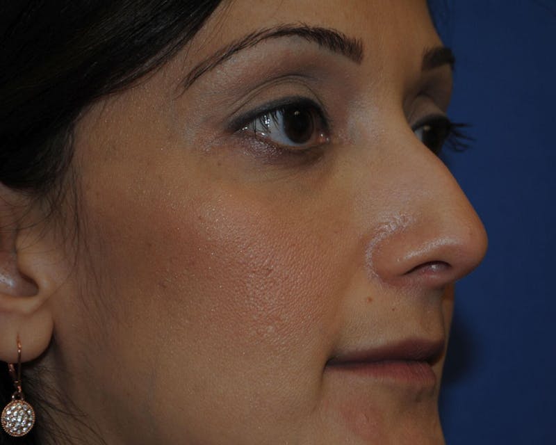 Dr. Robert Burk Before & After Gallery - Patient 438671 - Image 3