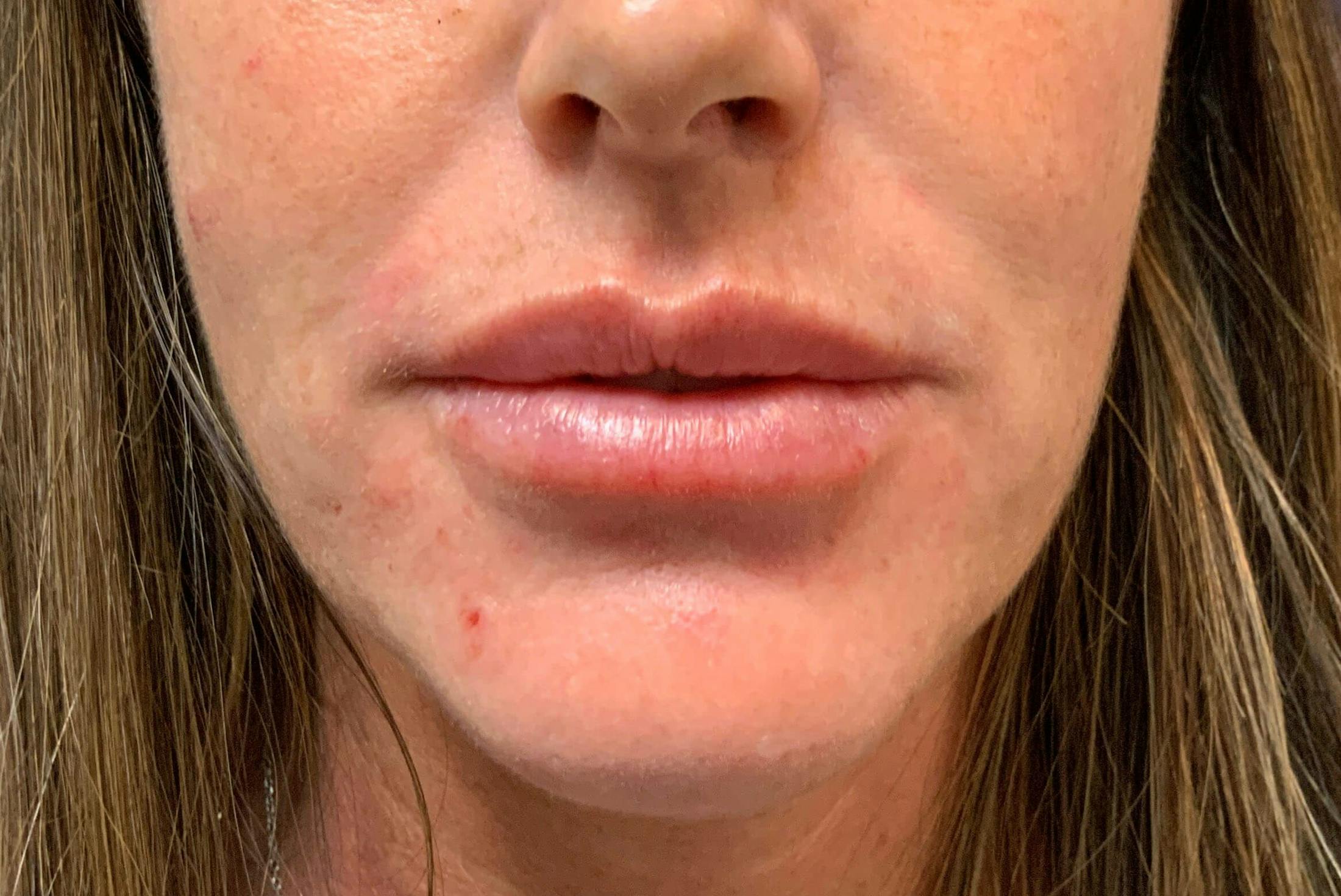 Amy Kadlubowski, APRN Before & After Gallery - Patient 343524 - Image 2