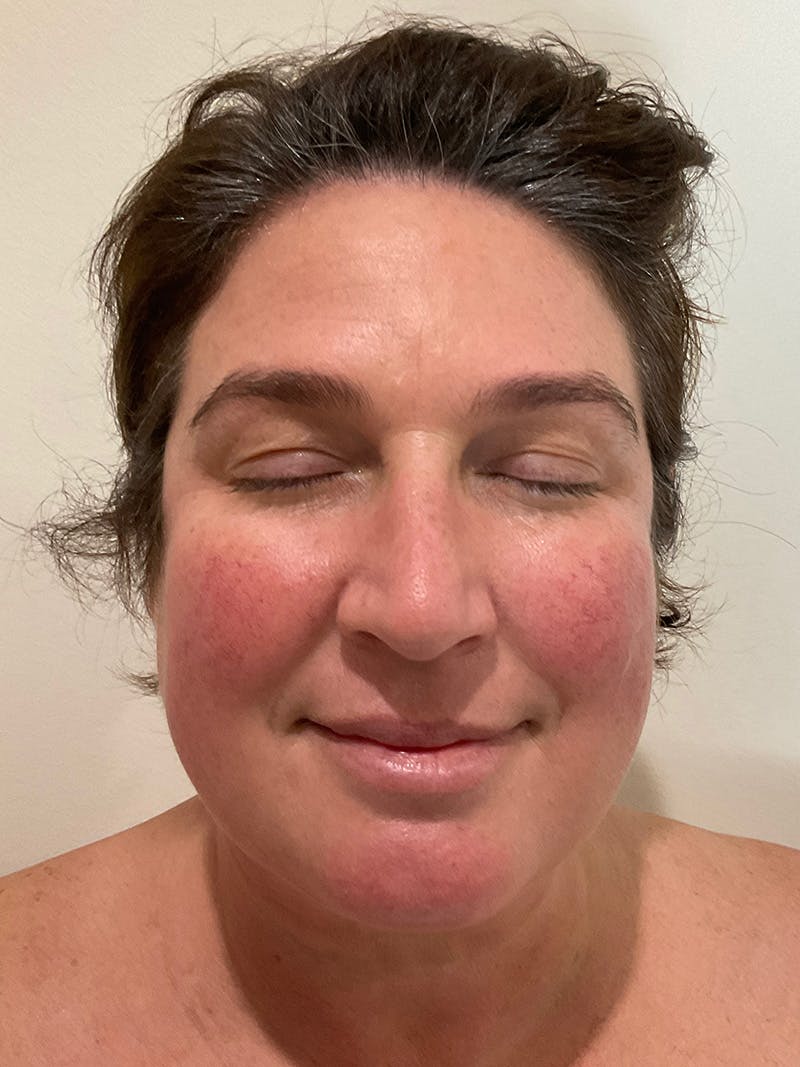 Jennifer Thurman-Olivieri, APRN Before & After Gallery - Patient 420818 - Image 1