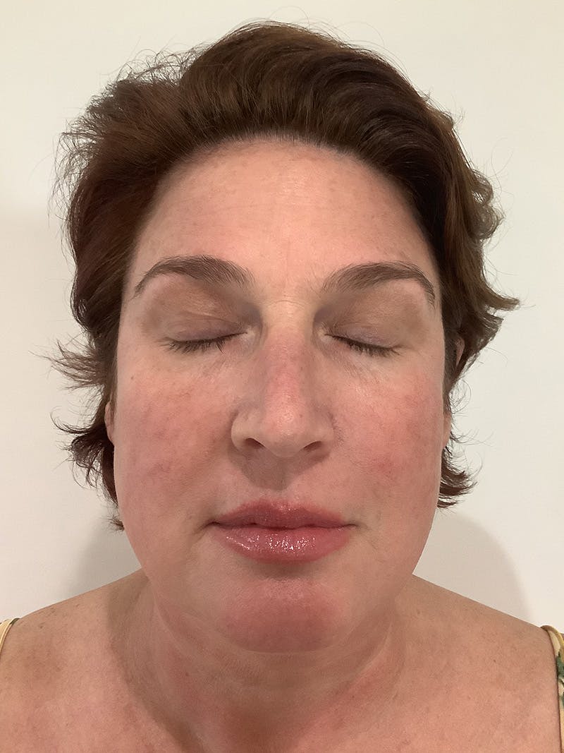 Jennifer Thurman-Olivieri, APRN Before & After Gallery - Patient 420818 - Image 2