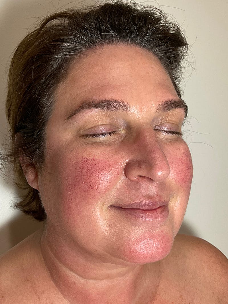 Jennifer Thurman-Olivieri, APRN Before & After Gallery - Patient 420818 - Image 3