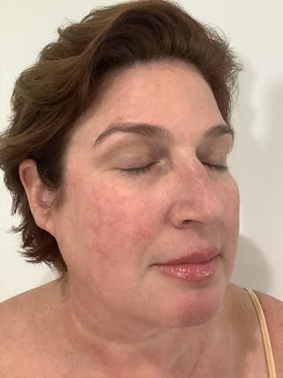Jennifer Thurman-Olivieri, APRN Before & After Gallery - Patient 420818 - Image 4