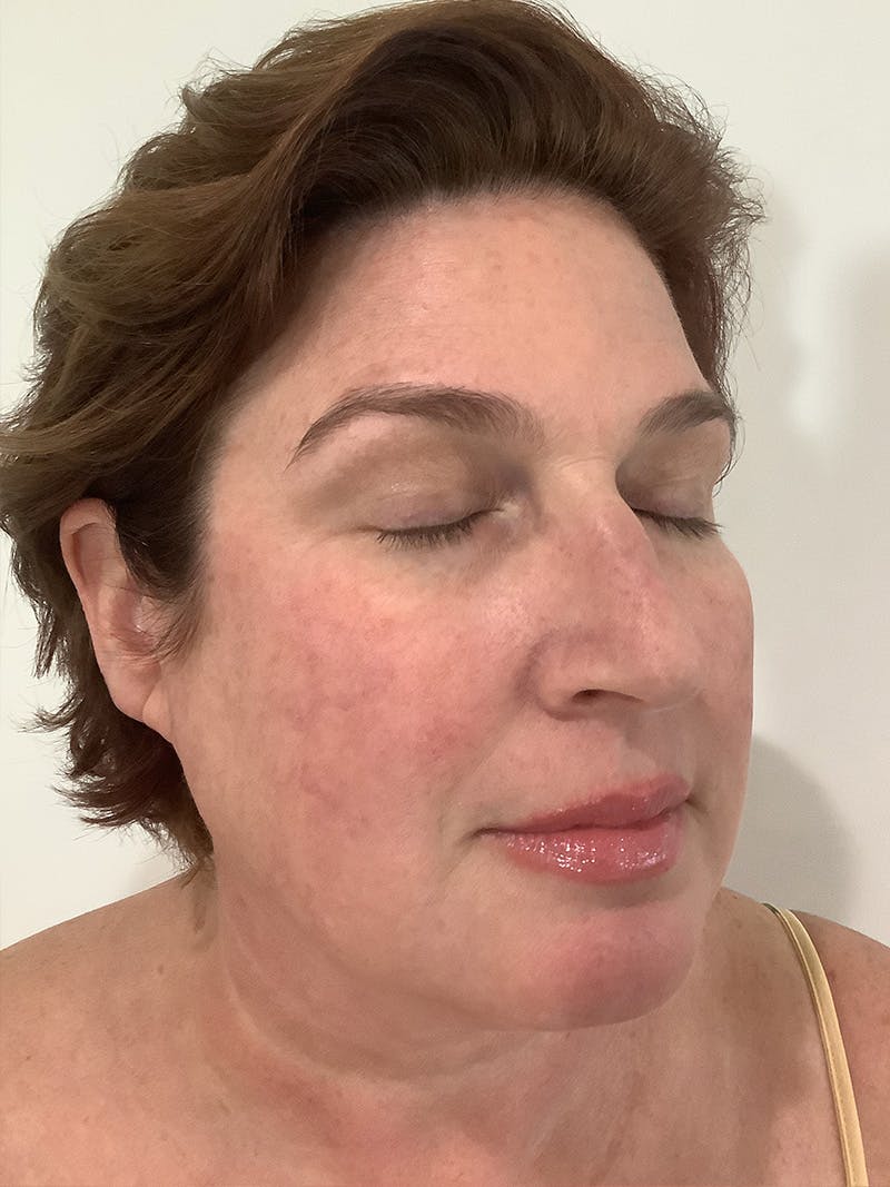 Jennifer Thurman-Olivieri, APRN Before & After Gallery - Patient 420818 - Image 4
