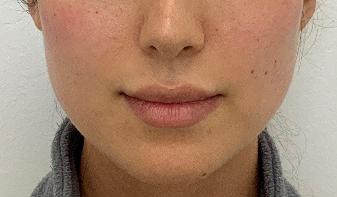 Amy Kadlubowski, APRN Before & After Gallery - Patient 901361 - Image 1