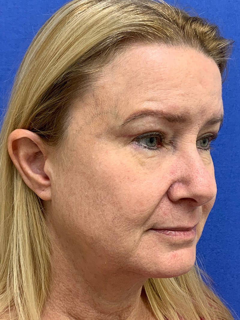 Dr. Ellen Hancock Before & After Gallery - Patient 348937 - Image 6