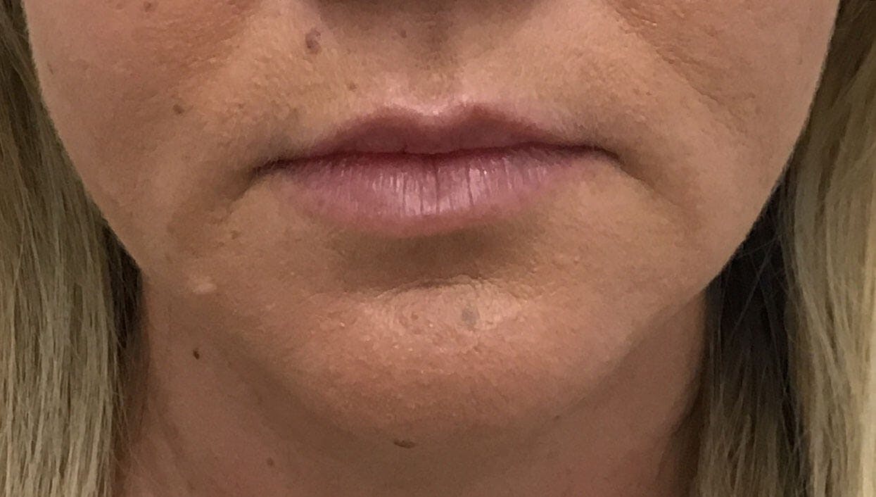 Amy Kadlubowski, APRN Before & After Gallery - Patient 373245 - Image 2