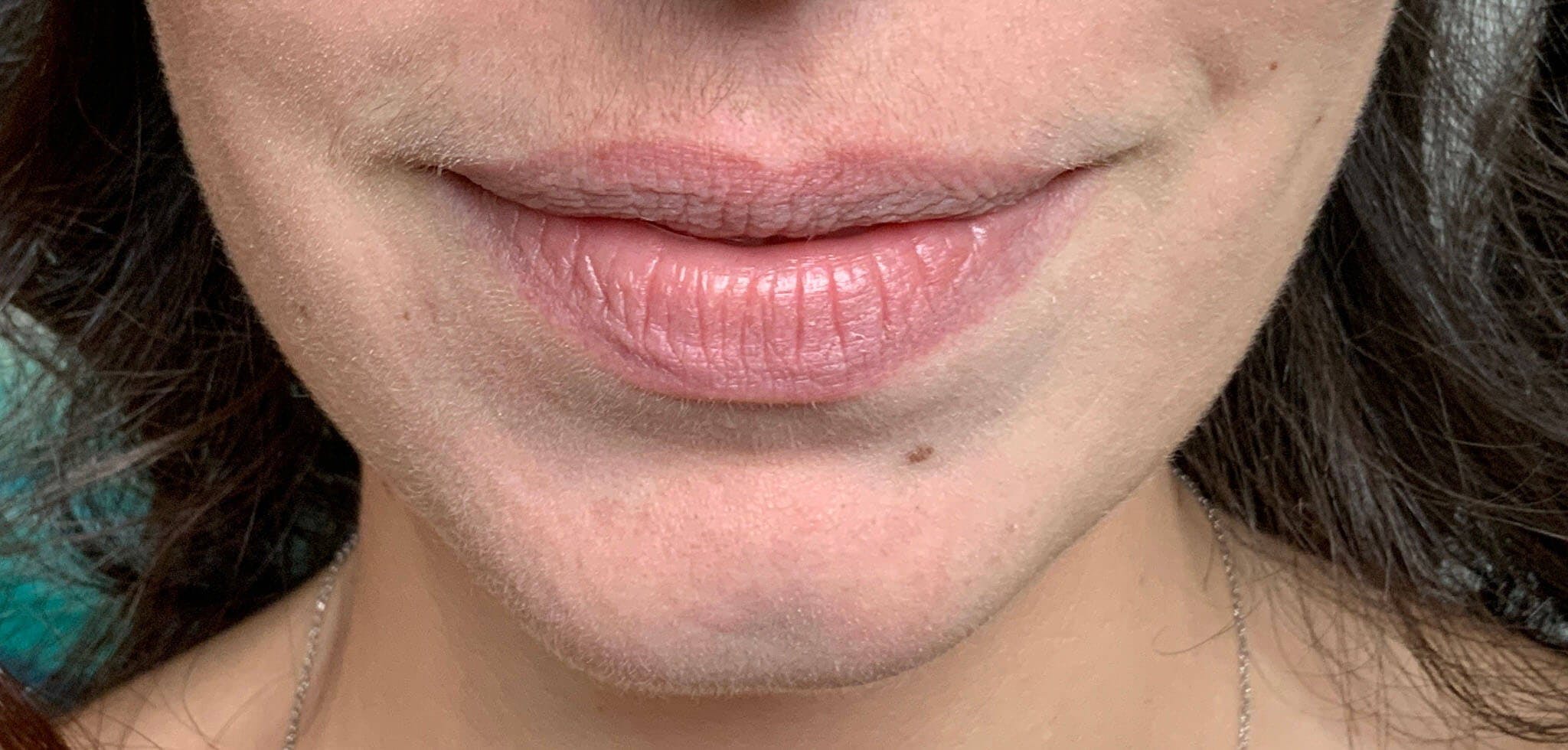 Kimberly Saffman, APRN Before & After Gallery - Patient 184630 - Image 1
