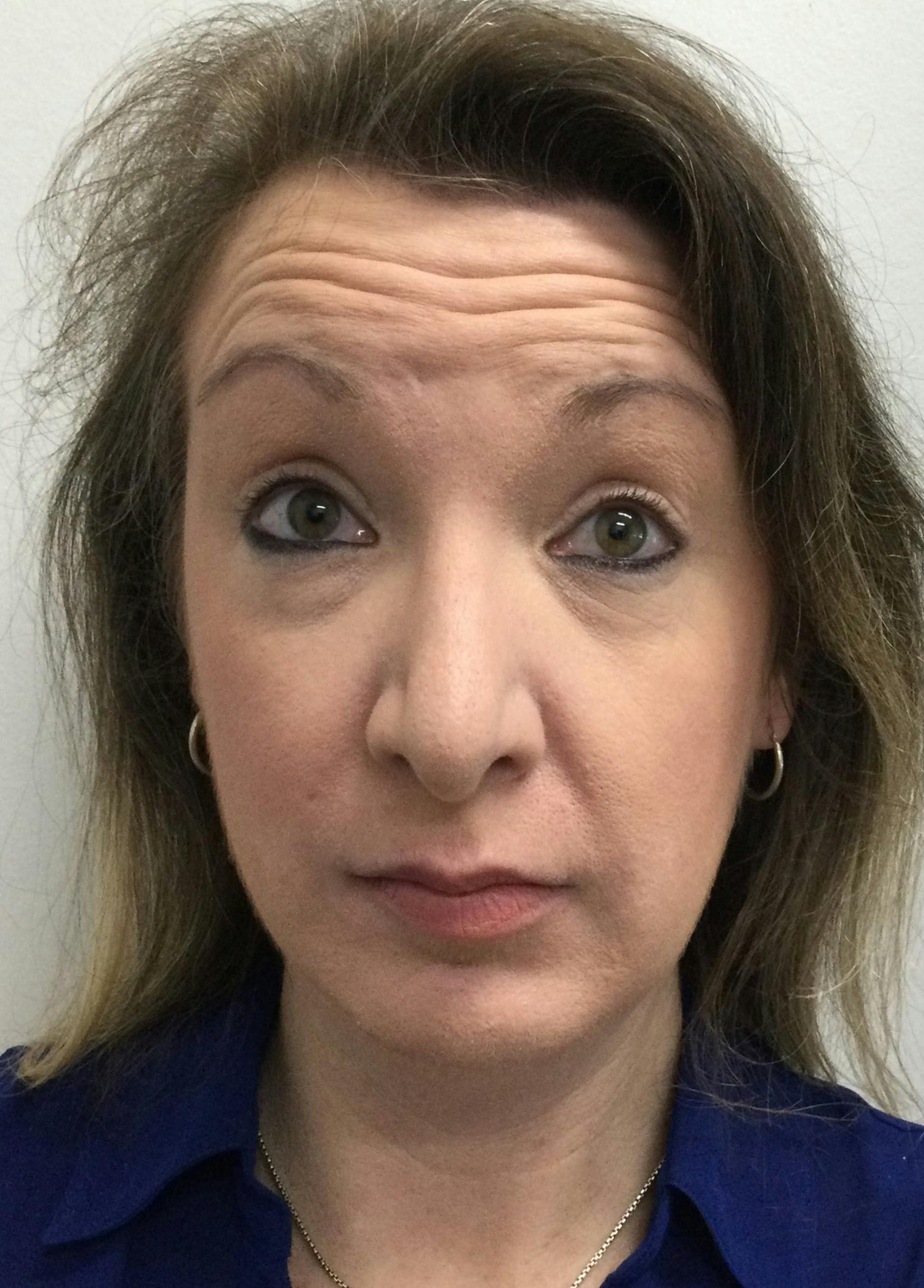 Carrie Cummings, DNP Before & After Gallery - Patient 364965 - Image 1