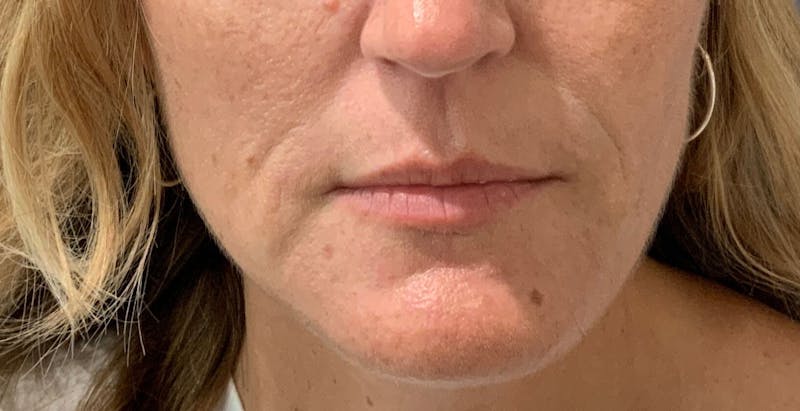 Kimberly Saffman, APRN Before & After Gallery - Patient 764598 - Image 1