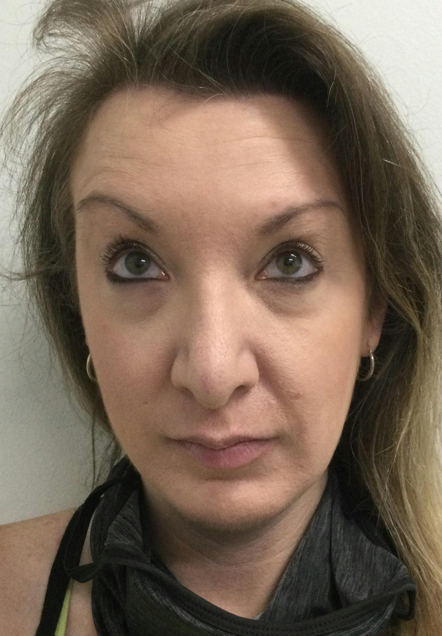 Carrie Cummings, DNP Before & After Gallery - Patient 364965 - Image 2