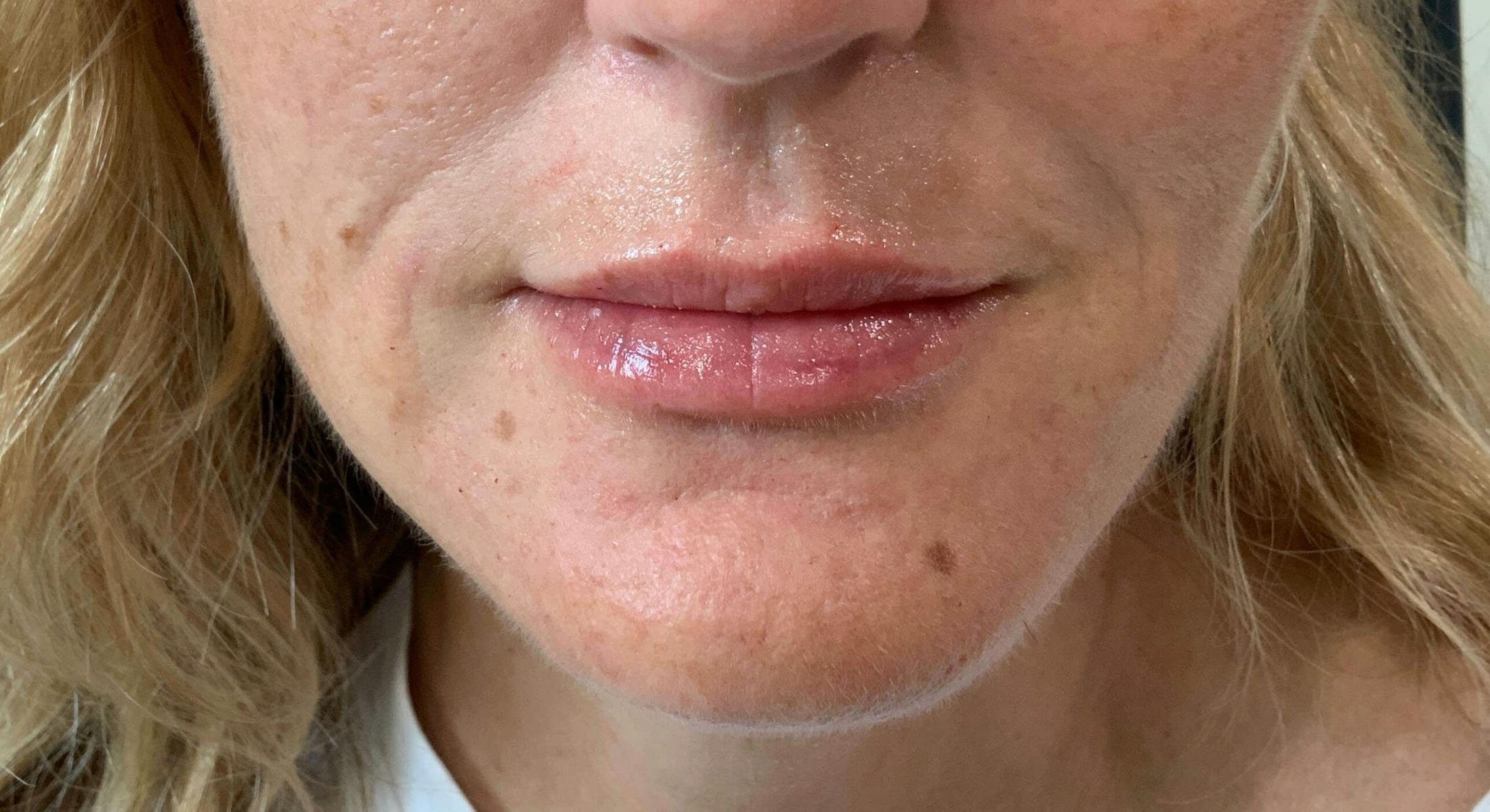 Kimberly Saffman, APRN Before & After Gallery - Patient 764598 - Image 2